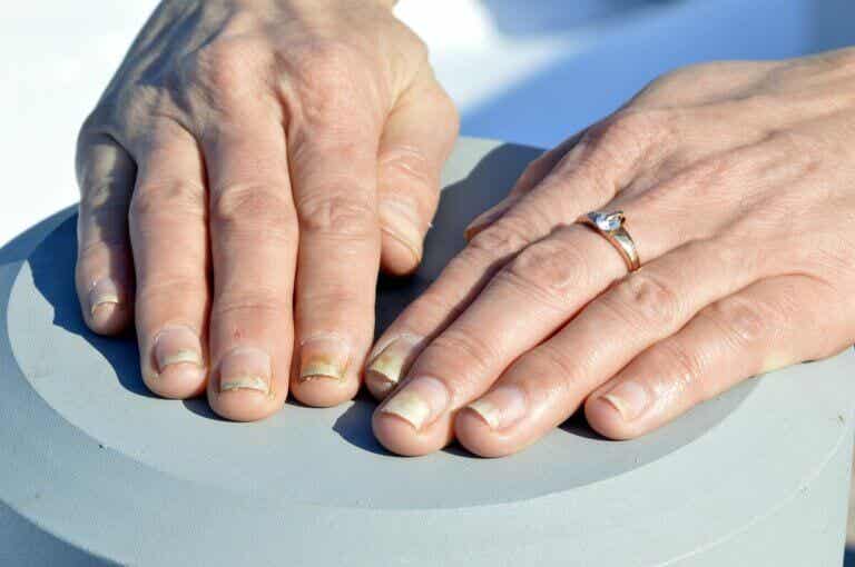 Cómo cuidar unas uñas con psoriasis