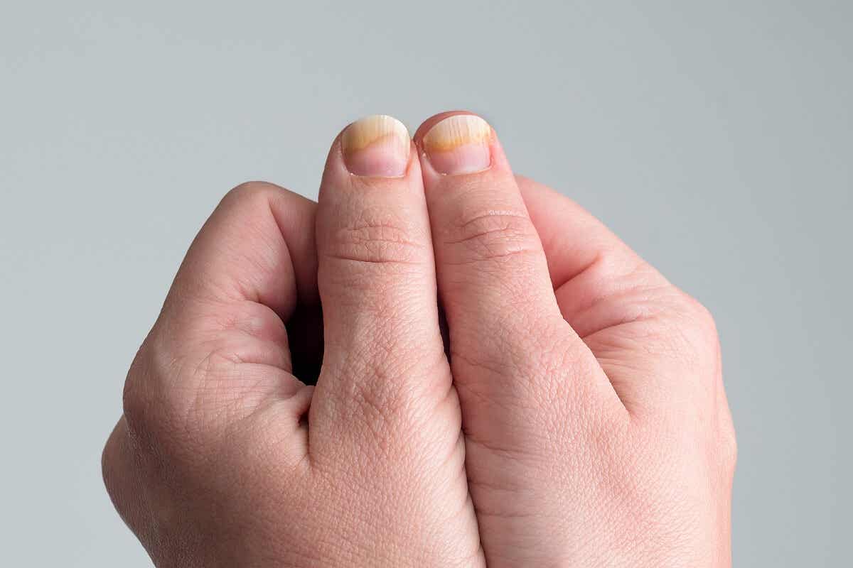 Expresión de la psoriasis en las uñas