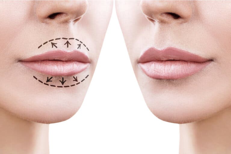 ¿En qué consiste la queiloplastia?
