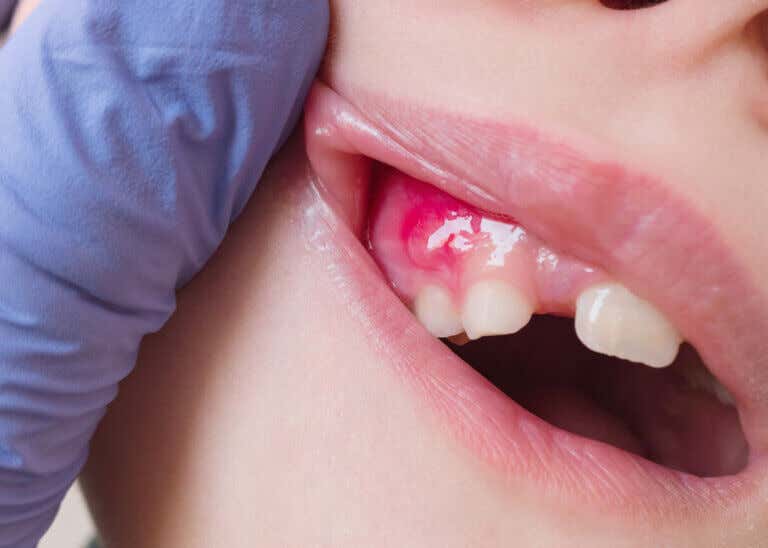 Flemón dental: qué es y cómo tratarlo