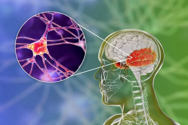 Síndrome de Wernicke-Korsakoff: una alteración mental por el consumo de alcohol
