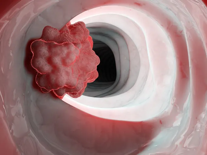 Las diferencias entre tumor y cáncer incluyen el crecimiento