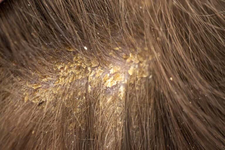 ¿Por qué salen costras en el cuero cabelludo? 13 posibles causas