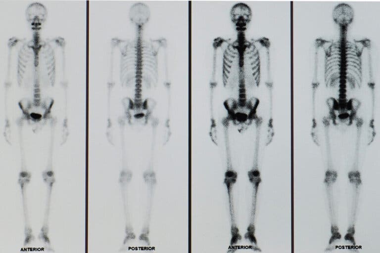 ¿Qué es una gammagrafía ósea?