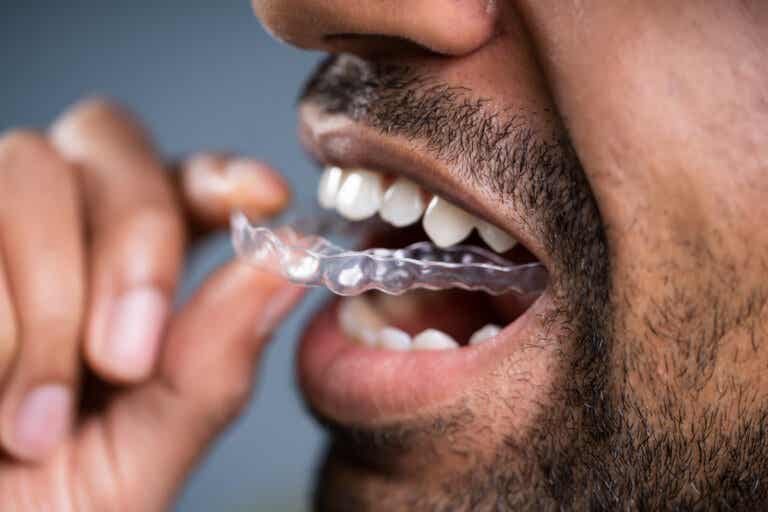 13 dudas que debes resolver antes de elegir ortodoncia invisible
