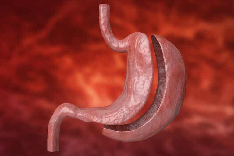 Tubular gastrectomy: what does it consist of?