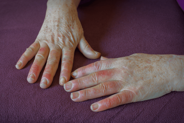 Enfermedad de Raynaud: síntomas, diagnóstico y tratamiento