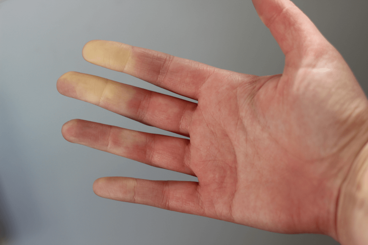Fenomeno di Raynaud