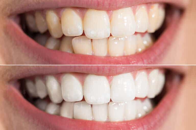 ¿Es seguro blanquear los dientes en casa? Posibles riesgos y recomendaciones