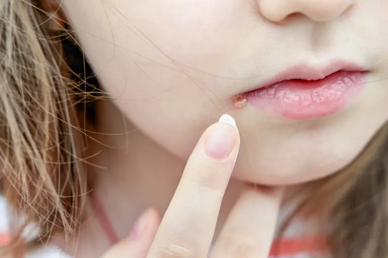 ¿Cómo diferenciar entre un grano y herpes labial?