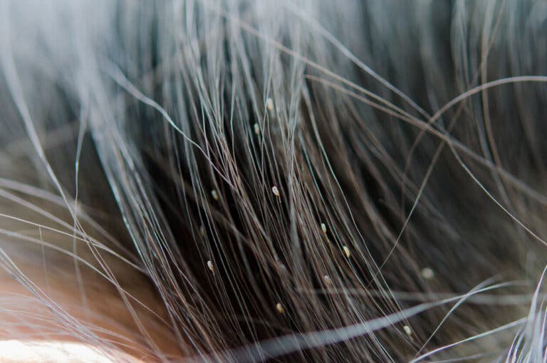Guía para identificar los piojos y sus rastros en la cabeza