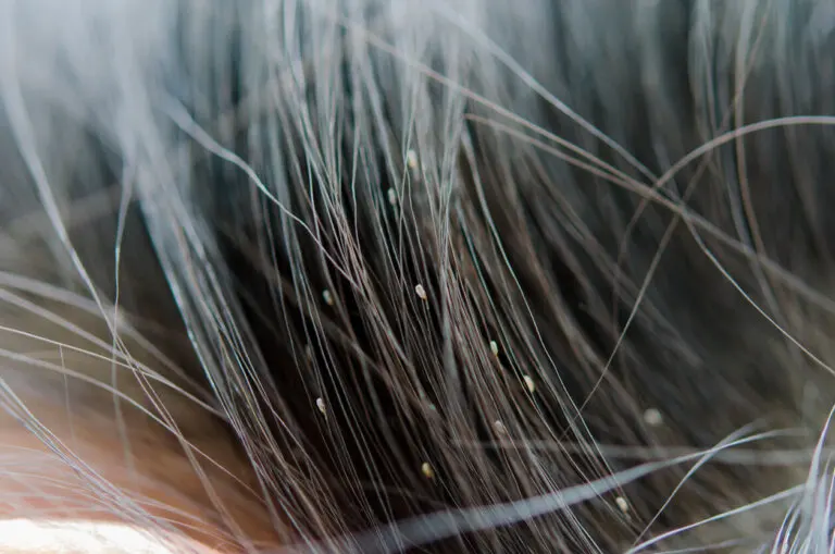 Guía para identificar los piojos y sus rastros en la cabeza