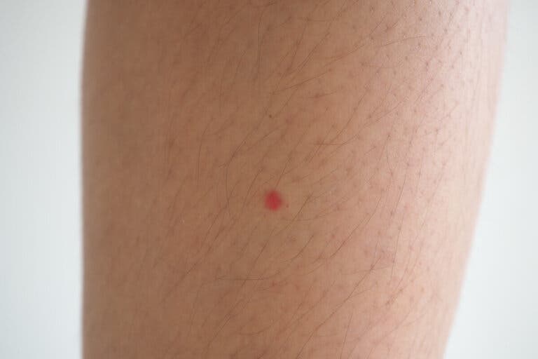 Manchas rojas en las piernas: ¿a qué se deben y qué puedo hacer?