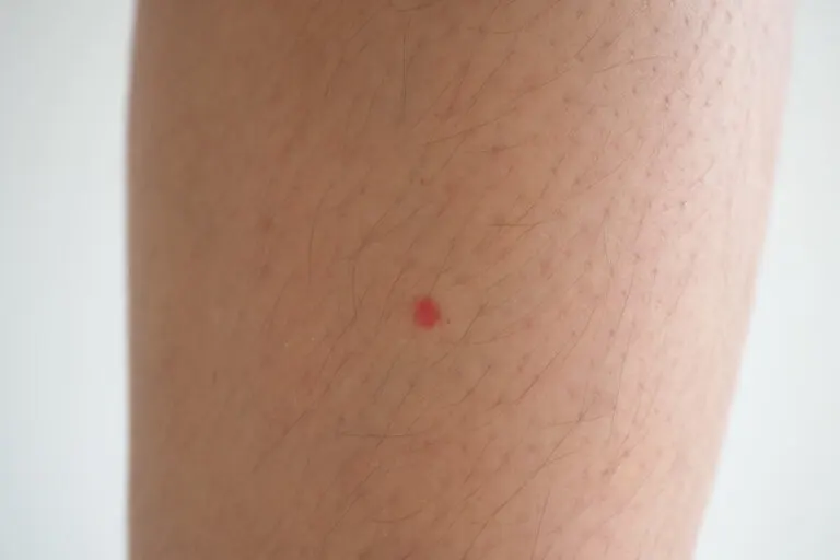 Manchas rojas en las piernas: ¿a qué se deben y qué puedo hacer?
