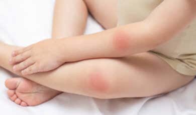 Manchas rojas en la piel: 25 posibles causas y tratamientos