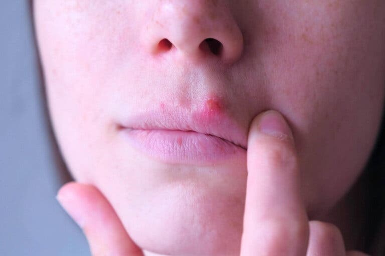 Herpes por estrés: ¿a qué se deben?