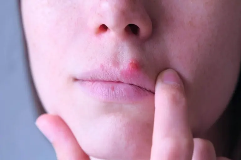 Herpes por estrés: ¿a qué se deben?
