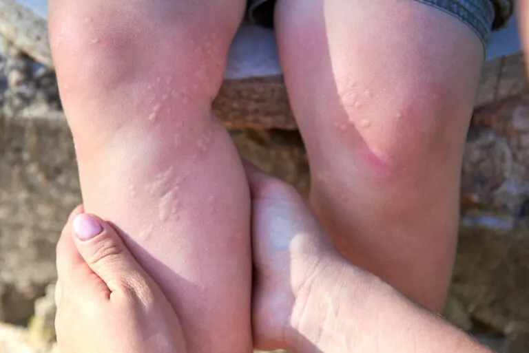 Urticaria: tipos, causas y prevención