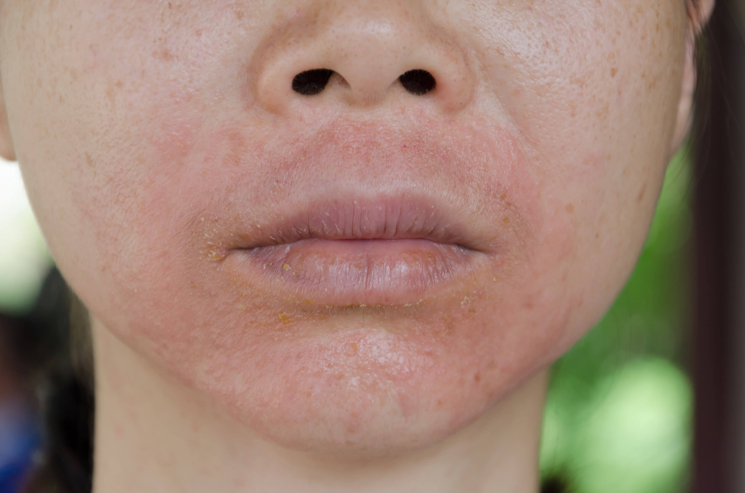 Infecções de pele: tipos, causas e tratamentos