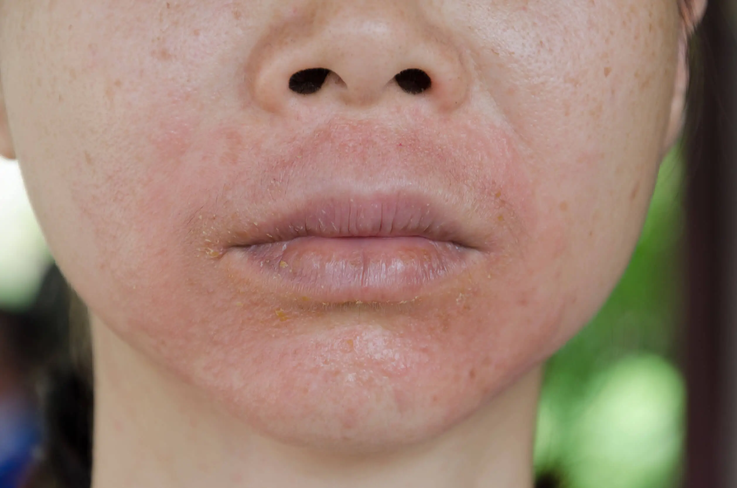 Infecciones de la piel: tipos, causas y tratamientos