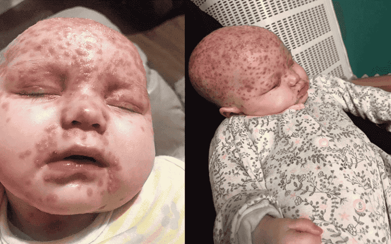 Niña de seis meses contrae herpes a causa de un beso
