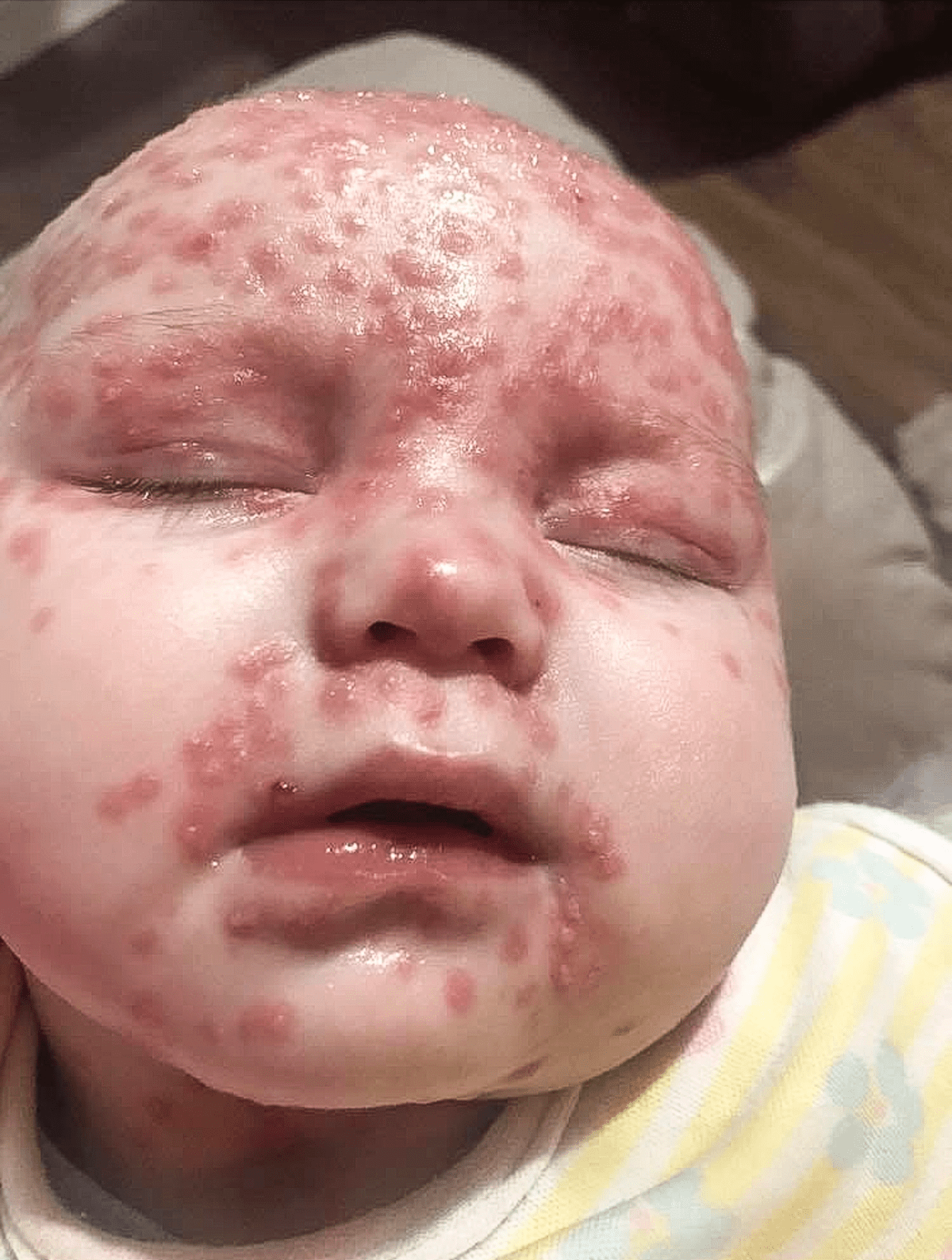 Le bébé avec l'herpès
