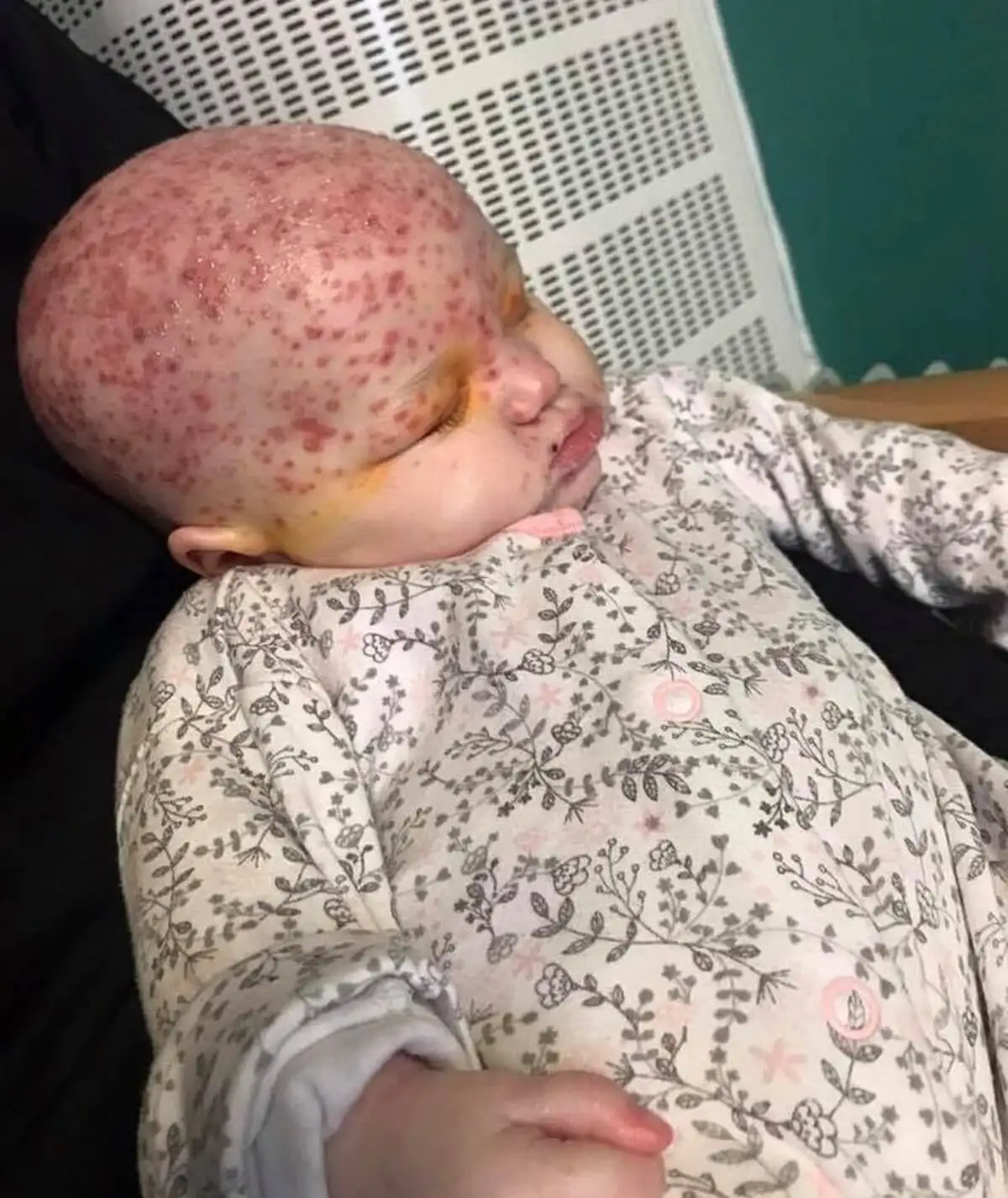 L'infection de la fille