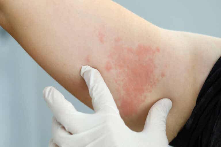 Infecciones de la piel: tipos, causas y tratamientos