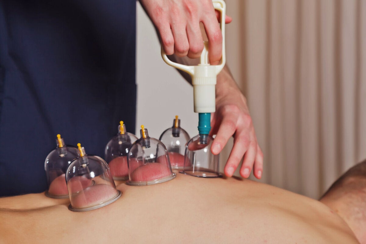 Cupping contraindicaciones best sale