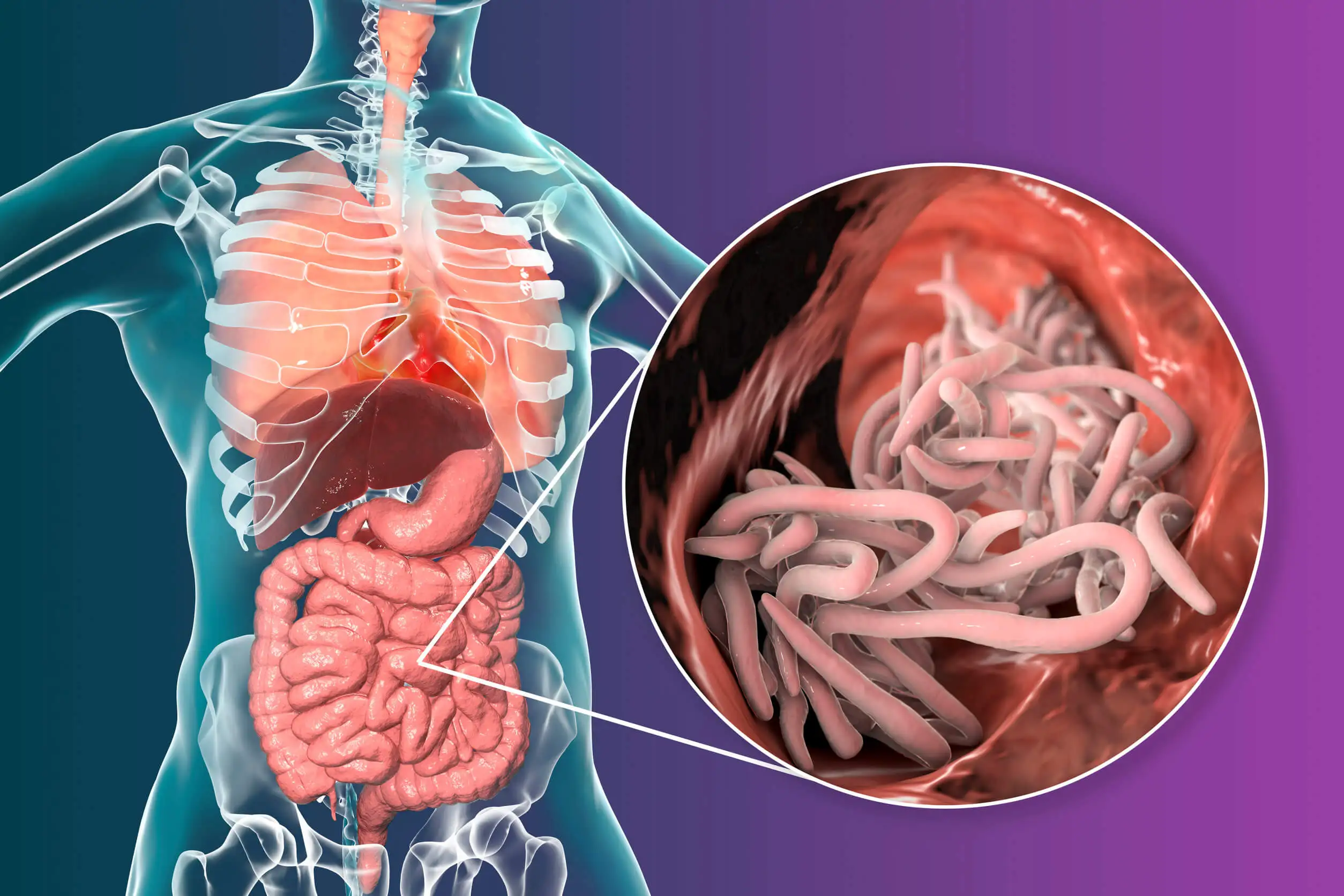 La ascariasis es una infección parasitaria