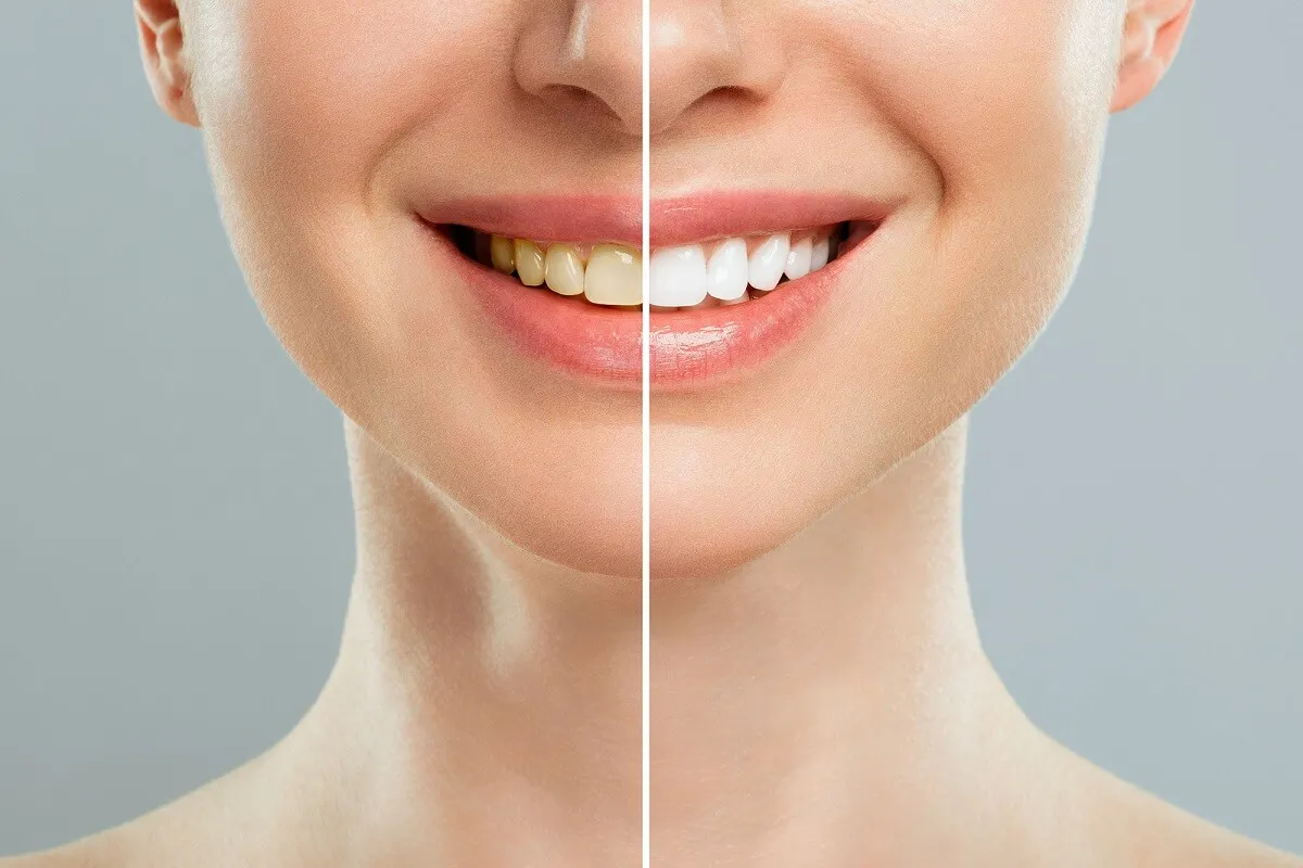 El verdadero blanqueamiento dental