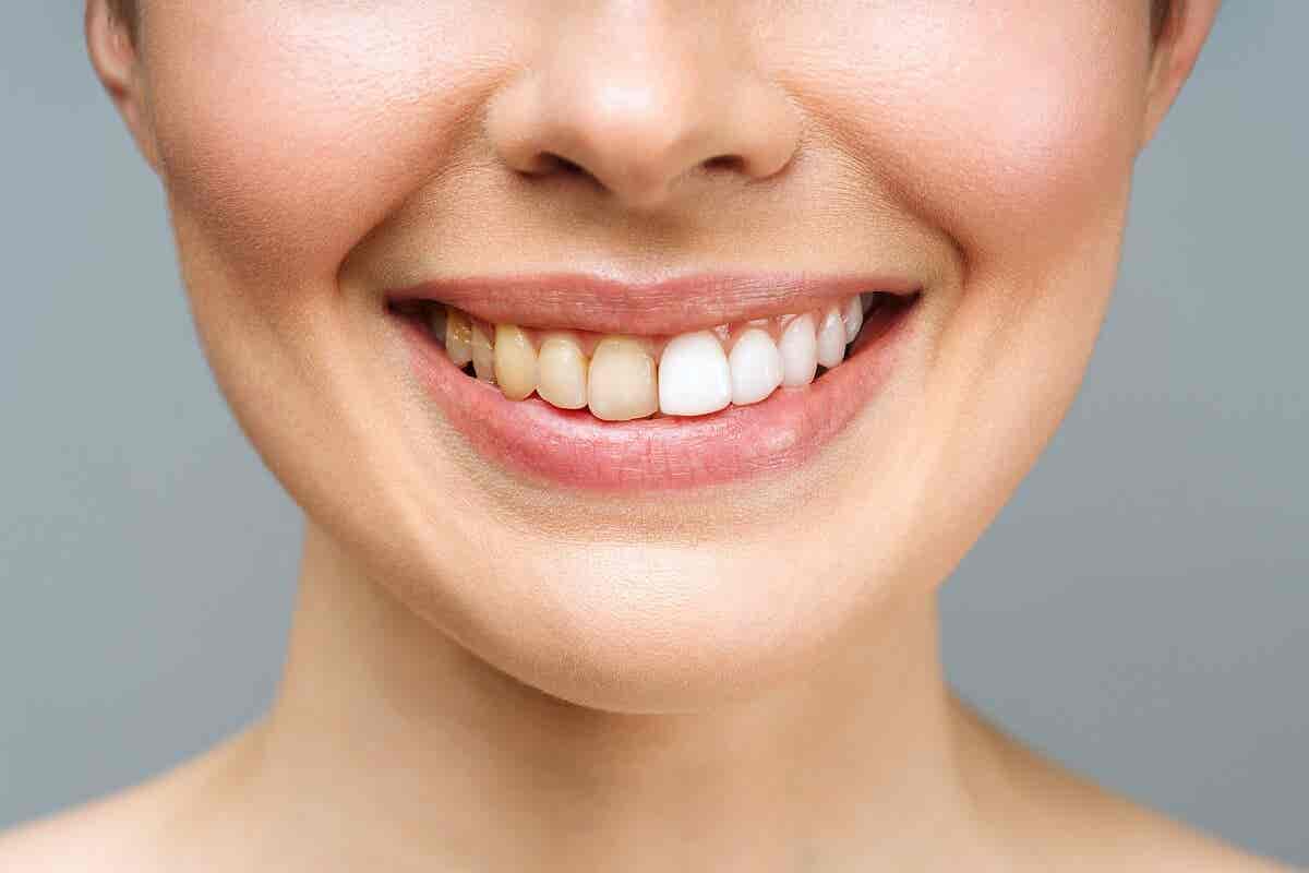 Mujer dientes amarillos