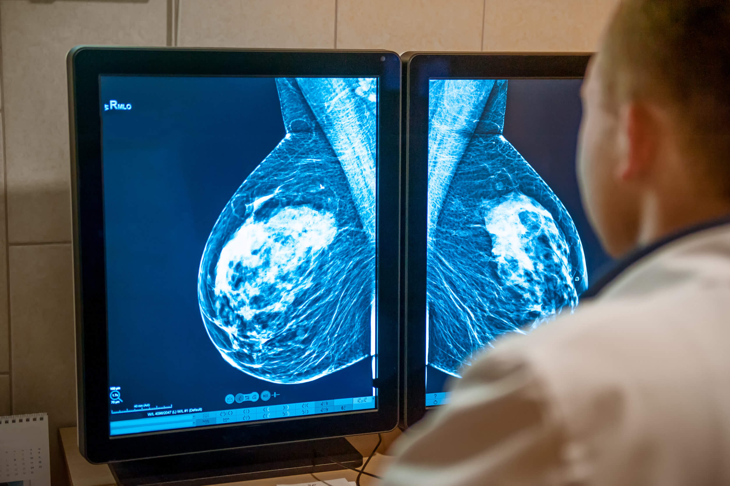 Mamografía para el diagnóstico de cáncer de mama que recibirá terapia de protones.