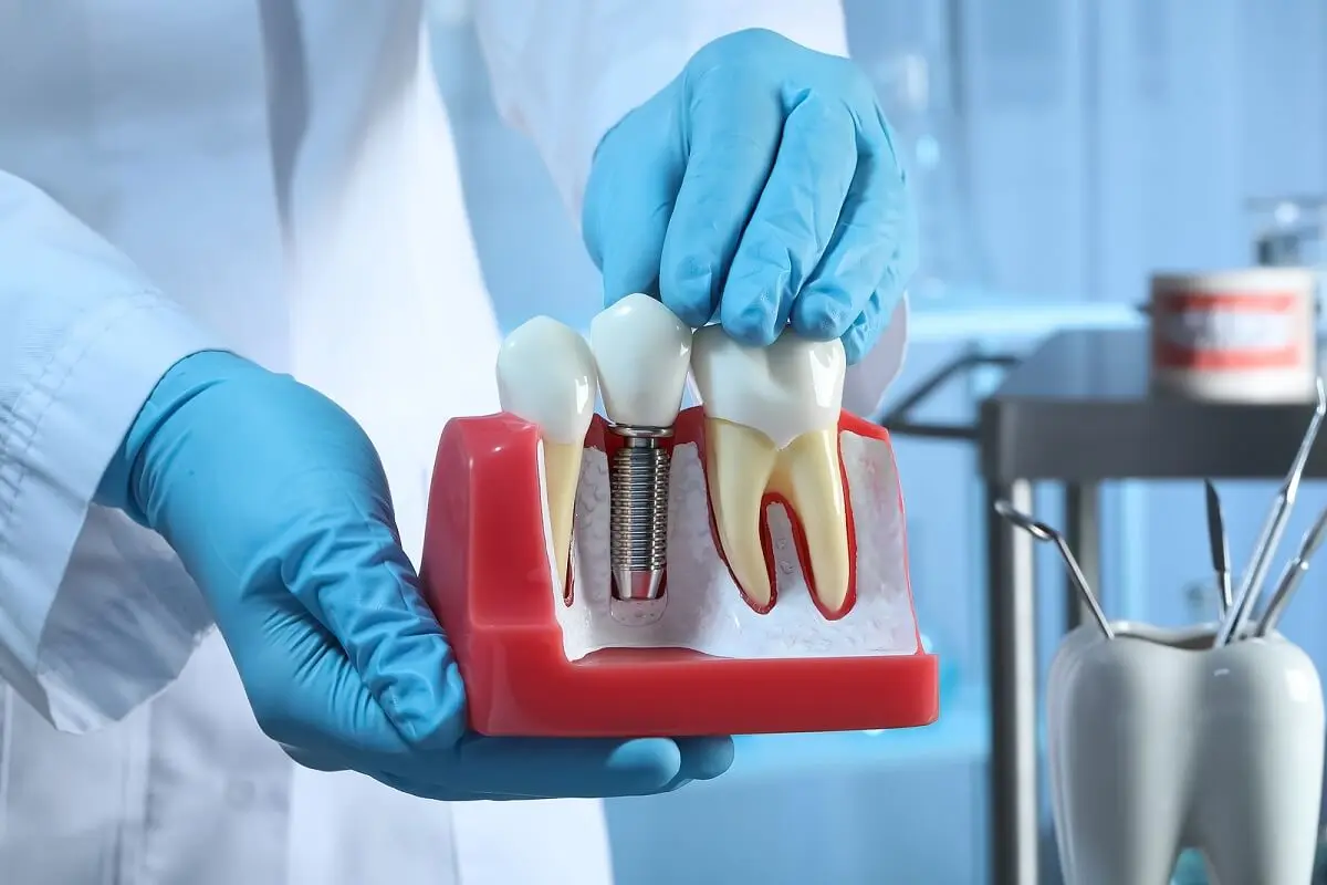 Implant dentaire sur modèle.