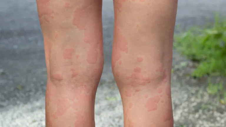 10 remedios caseros y naturales para tratar la urticaria