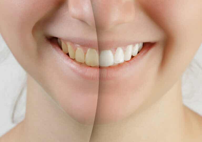 El blanqueamiento dental daa los dientes?