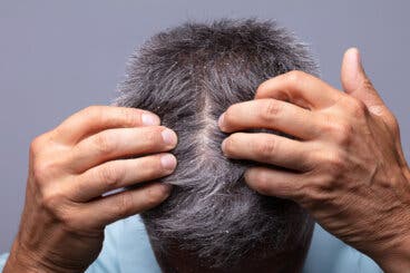 6 aceites esenciales que ayudan a combatir la caspa
