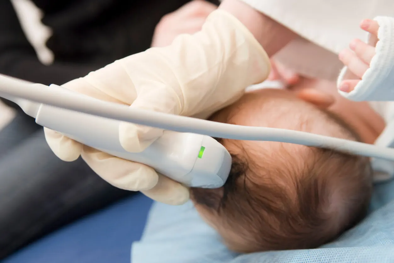 Étude de la craniosténose chez un bébé.