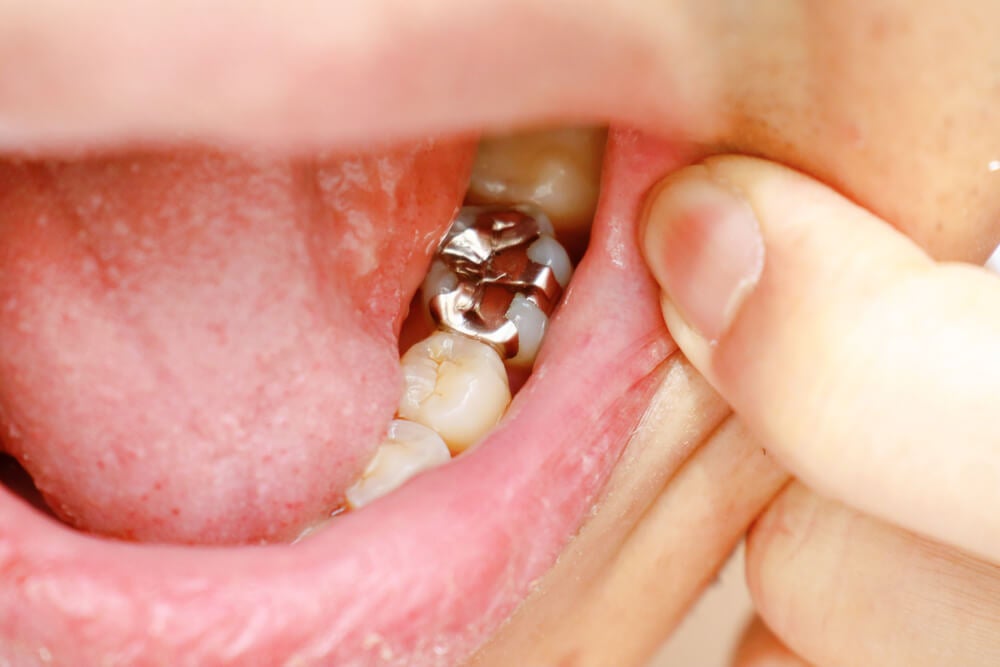 Resina dental o amalgama: ¿cuál es mejor?