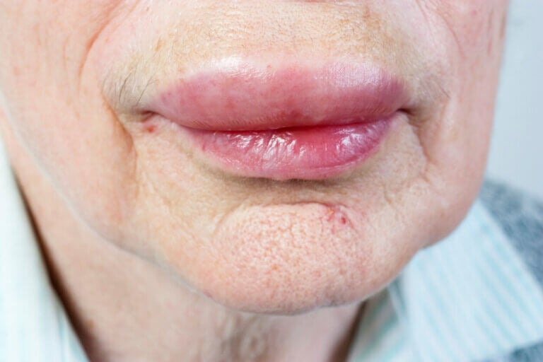 12 causas de los labios hinchados