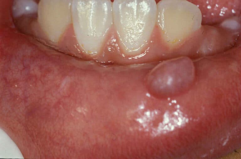 Mucocele: qué es, cuáles son sus causas, síntomas y tratamientos