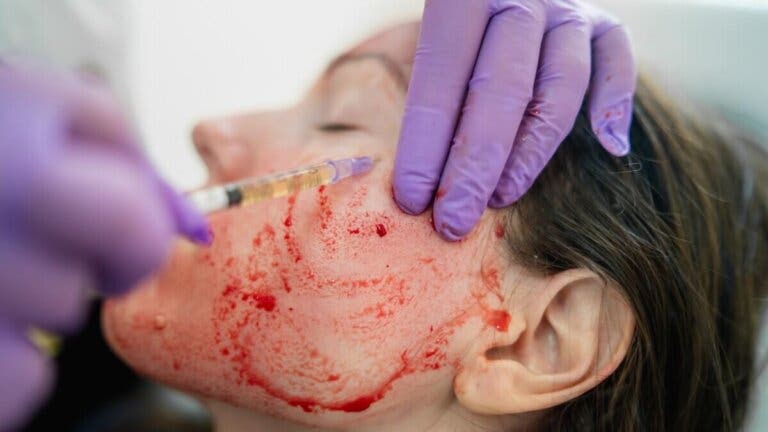 Facial de vampiro: qué es y cuáles son sus riesgos