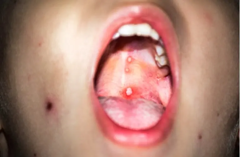 Gingivoestomatitis en niños: ¿qué es y cómo actuar?
