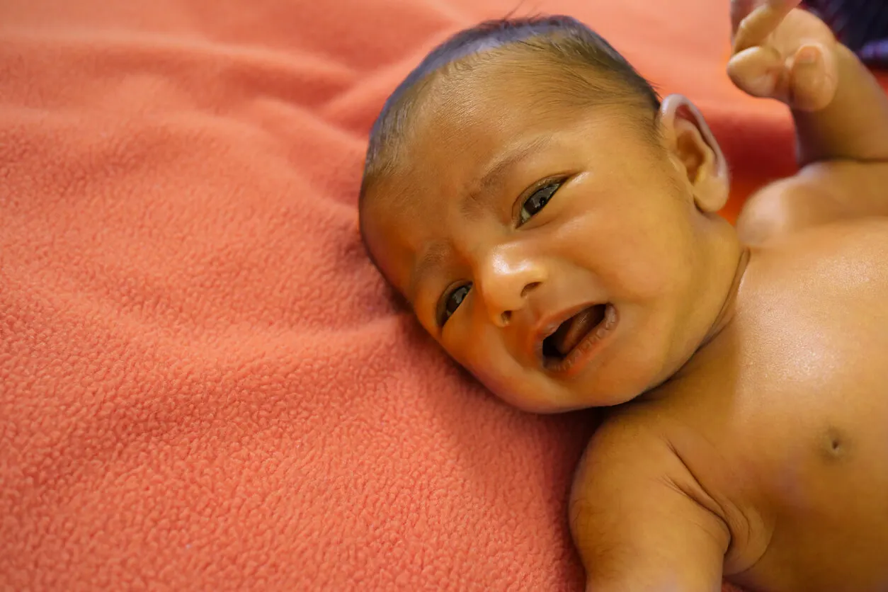Jaundice in a baby