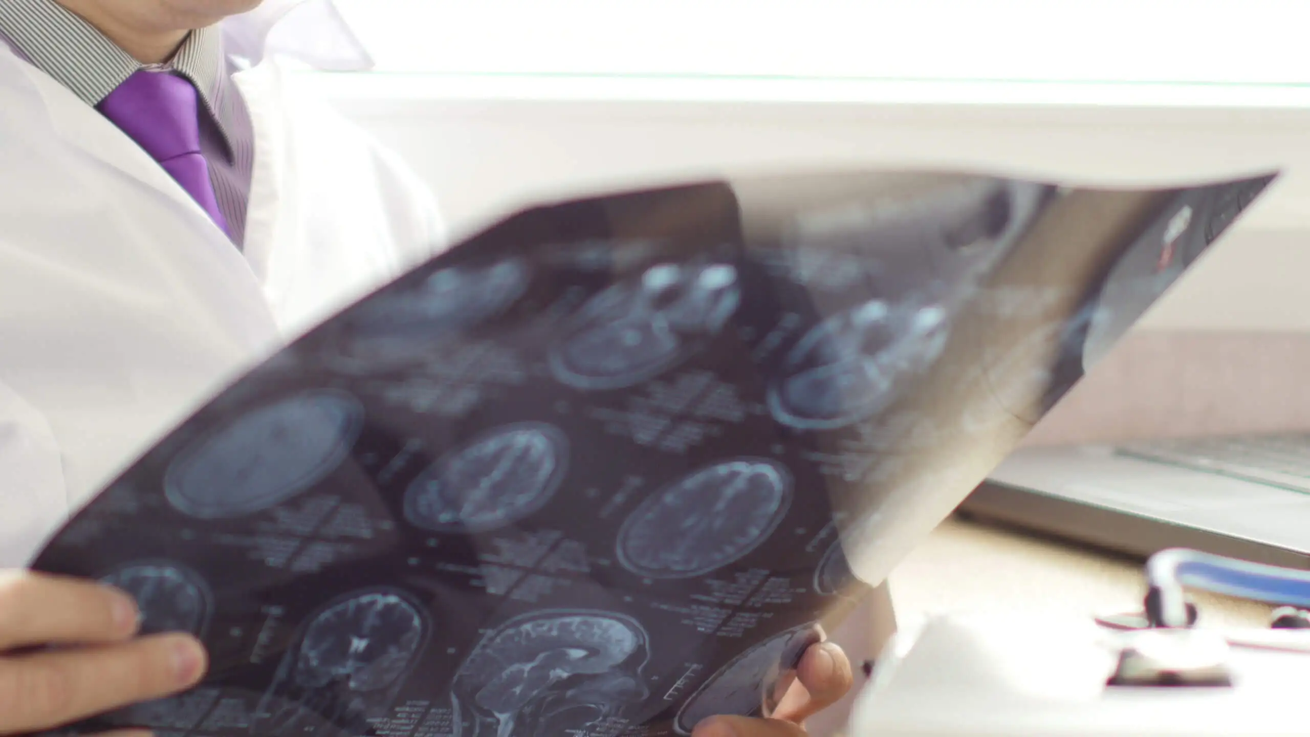 An MRI scan looking at multiplr sclerosis relapses.