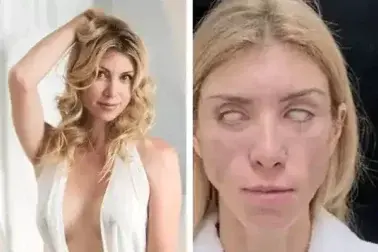 Exseñorita pierde la capacidad de cerrar los ojos después de un error de cirugía plástica