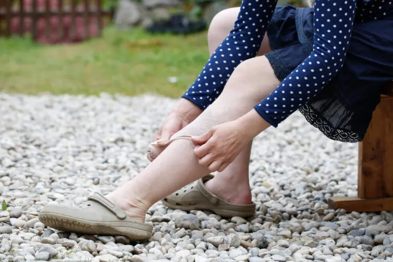 5 hábitos saludables para aliviar las varices