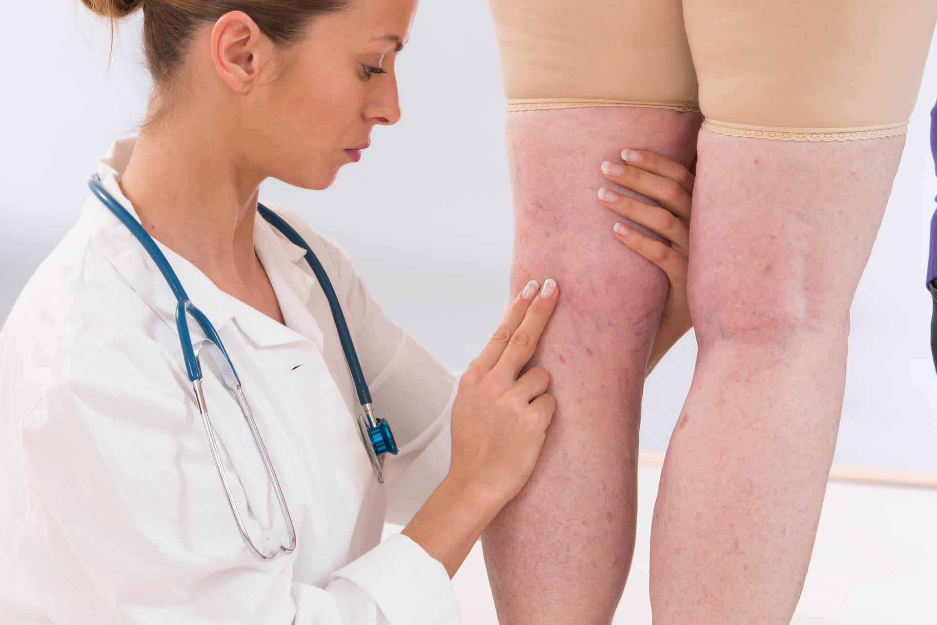 Le vene varicose sono sinonimo di cattiva circolazione nelle gambe e nei piedi.