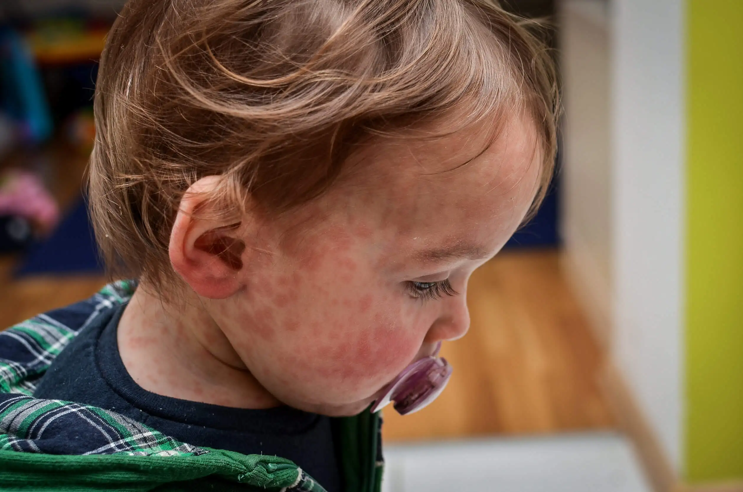 Alergia cutánea de niña.