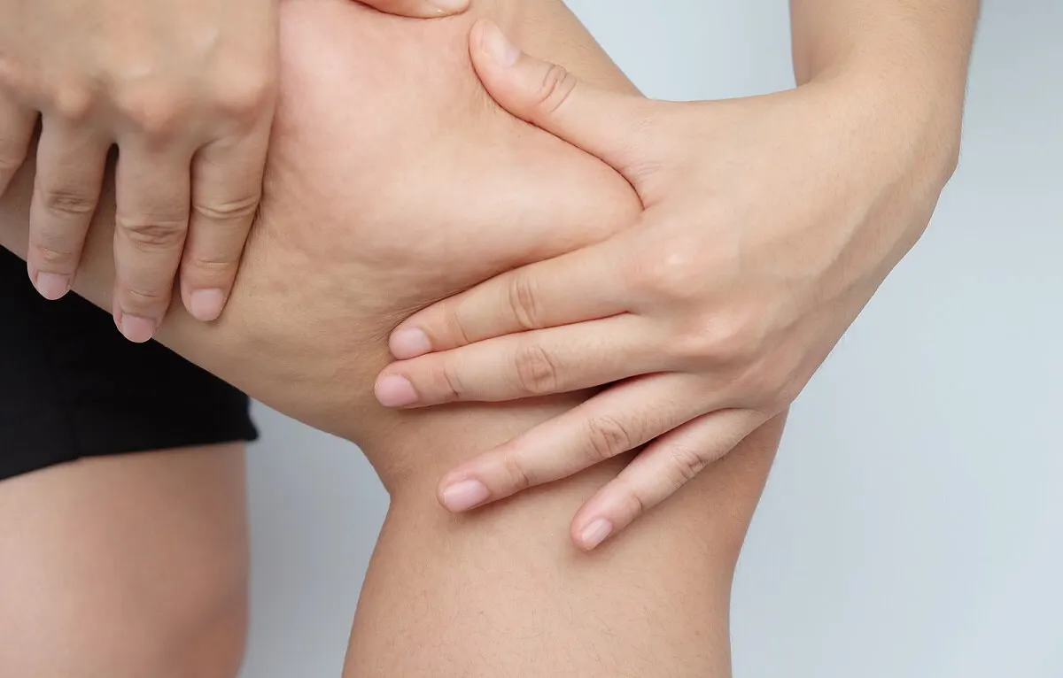 ¿Qué es la celulitis?